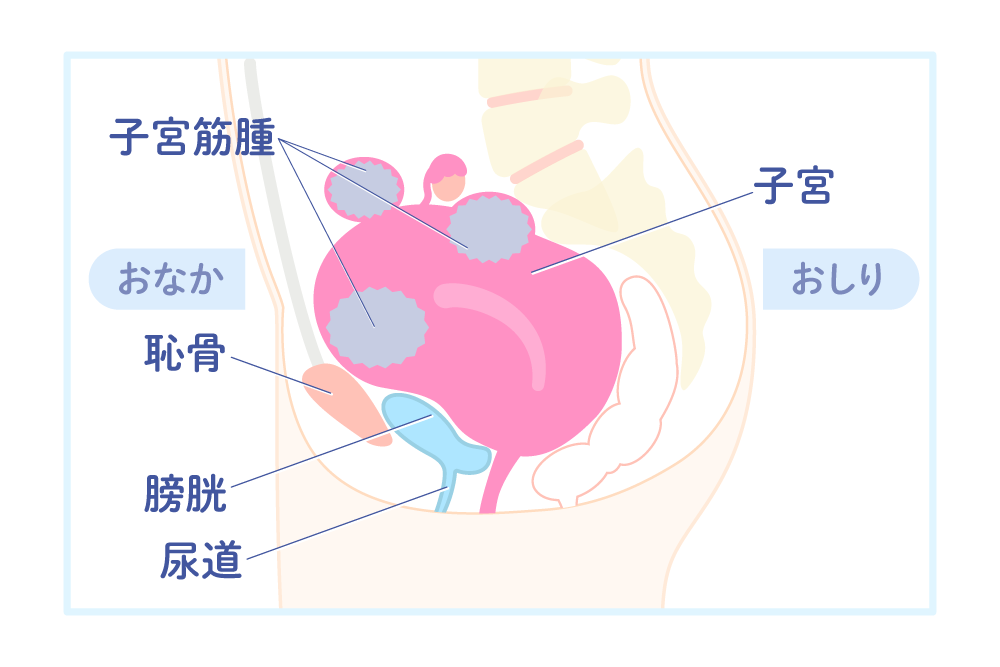 子宮筋腫の拡大による排尿障害