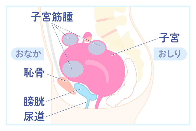 子宮筋腫の拡大による排尿障害